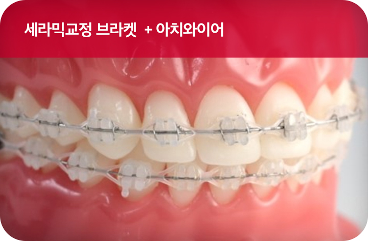 강남치아교정 브라켓비교분석 관련 이미지 13