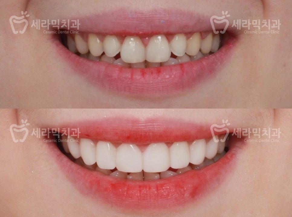 치아교정 VS. 라미네이트. 뭐가 좋은 걸까요? 관련 이미지 7