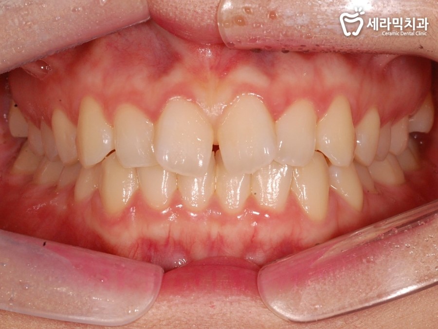 세라믹치과 앞니부분교정 관련 이미지 5