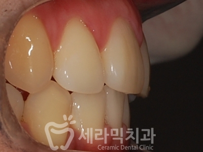 덧니와 돌출입을 한번에! 치아교정 전후사진 관련 이미지 21