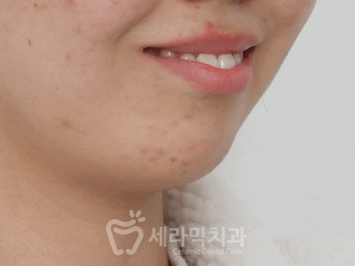 Before and After Orthodontic Treatment for Protruding Mouth and Deep Bite: A Calmer, More Sophisticated Transformation! image 12