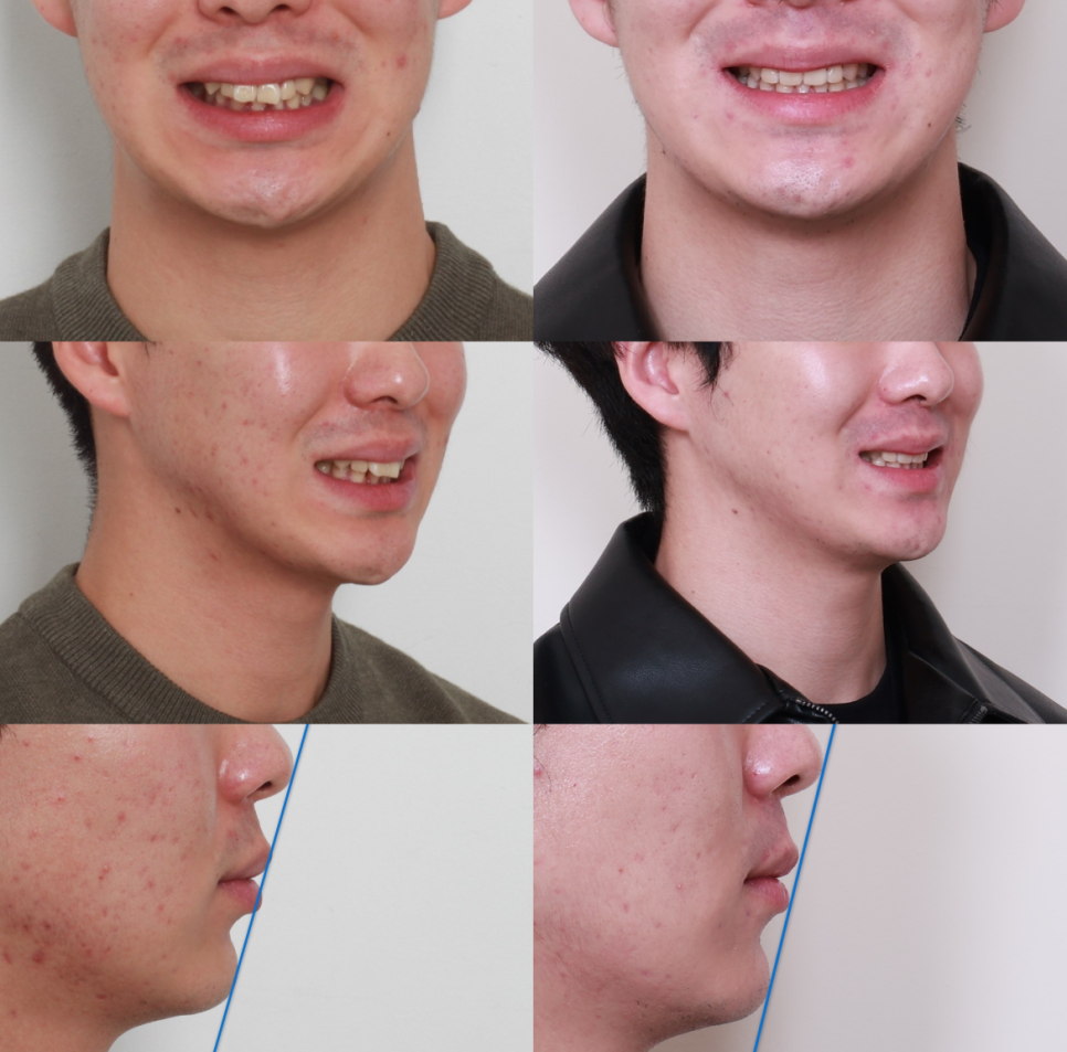 결손치를 임플란트 없이 교정으로 치료한 사례 관련 이미지 13