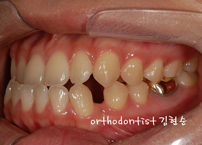 반대 교합 관련 이미지 10