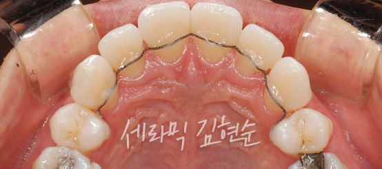 세라믹교정 가격 4대부작용 관련 이미지 9