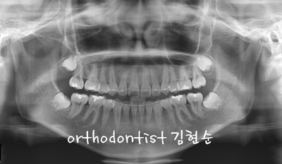 강남 덧니 관련 이미지 33