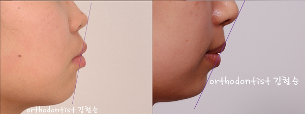 학동역 치아교정, 돌출입 세라믹교정 관련 이미지 2