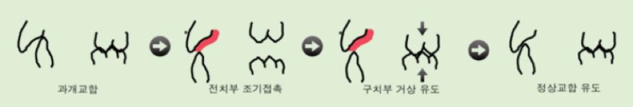 과개교합 무턱 개선 관련 이미지 8