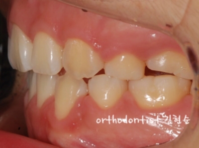 강남치아교정추천 관련 이미지 25