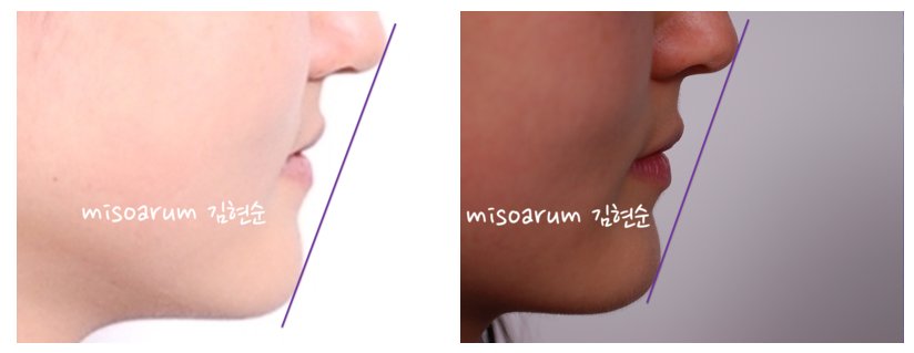 치아의 배열을 개선, 발치하지 않고 교정하기 관련 이미지 8