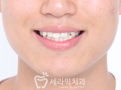 치아배열 치아교정전후 : 함박웃음을 찾은 사례 관련 이미지 2