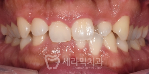 A Case of Overretained Teeth and Deep Bite Orthodontics That Helped the Patient Smile Confidently Before and After image 4