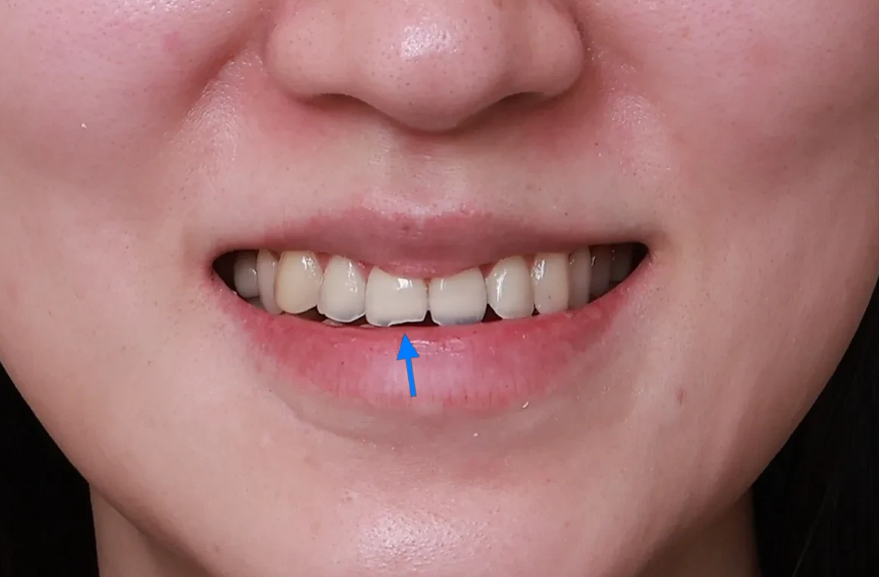치아부식과 심미성을 동시에 잡은 앞니 치료 (ft. 역류성 식도염) 관련 이미지 4