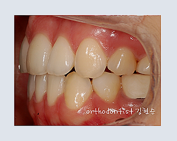 강남교정치과 관련 이미지 24