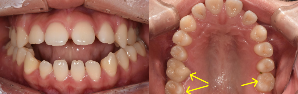 학동역 교정치과, 개방교합과 비대칭을 수술없이 교정한 경우 관련 이미지 2