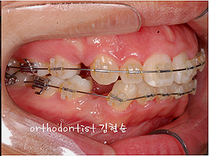 강남 돌출입 교정 관련 이미지 25