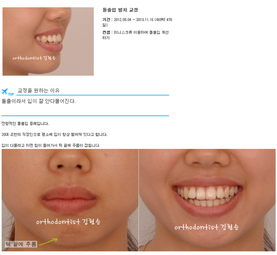 세라믹교정 세라믹치과-돌출입발치교정 6 관련 이미지 1