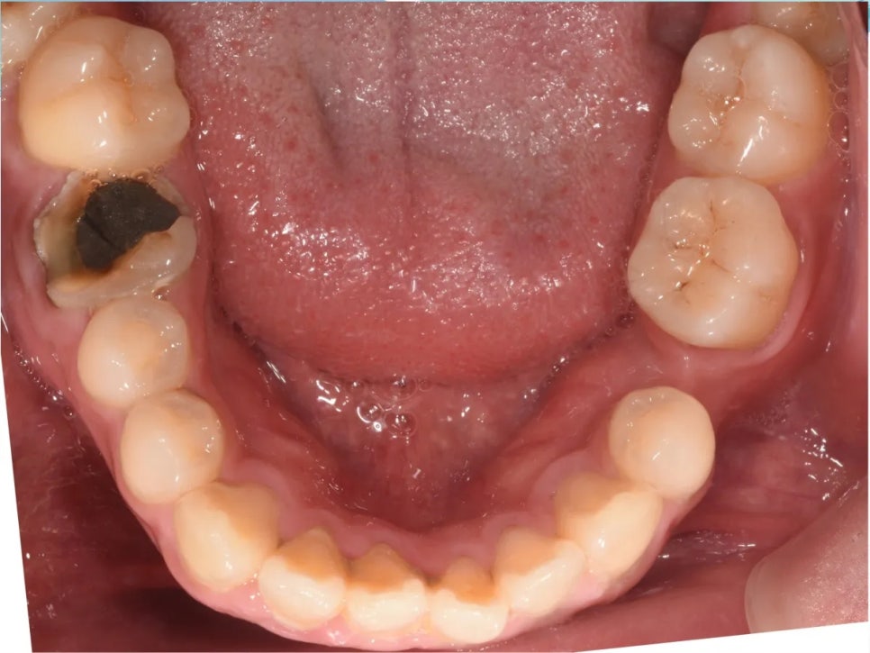 돌출입 교정 전후, 그런데 과개교합까지 있으셨던 환자분 관련 이미지 4
