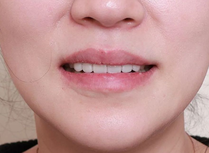 치아부식과 심미성을 동시에 잡은 앞니 치료 (ft. 역류성 식도염) 관련 이미지 12