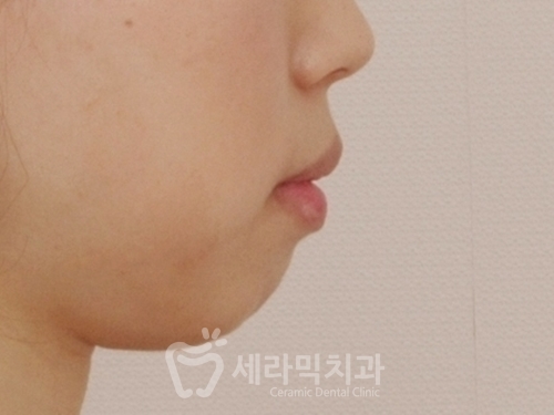 20대 돌출입교정, 무턱교정, 치아교정전후 세련된 얼굴 라인을 되찾다! 관련 이미지 6