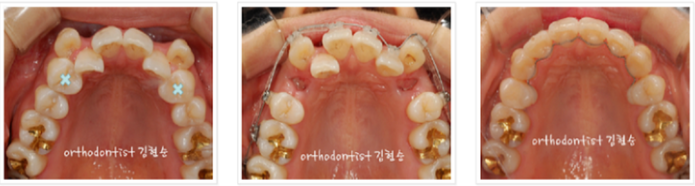 강남 덧니 관련 이미지 10