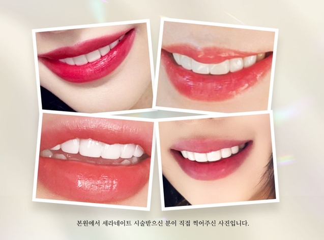 강남라미네이트치과 세라네이트 전후 사례 - 달라진 스마일라인 관련 이미지 1