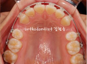 강남 돌출입 교정 관련 이미지 19