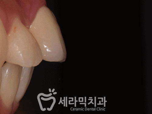돌출입 치아벌어짐 치아재교정 전후. 세라믹치과 관련 이미지 7