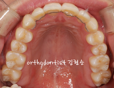 반대교합 관련 이미지 20