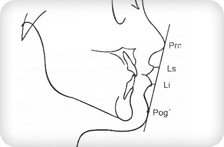 돌출입 비발치 치아교정 관련 이미지 3