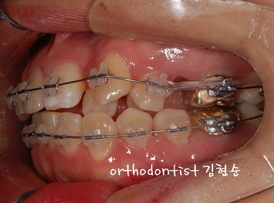 강남 덧니, 돌출 관련 이미지 23