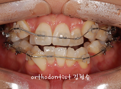 강남 덧니 관련 이미지 15