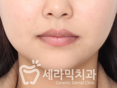 토끼이빨, 틀어진 치아배열 세라믹교정 전후사진 관련 이미지 14