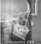 강남 돌출입 교정 관련 이미지 22