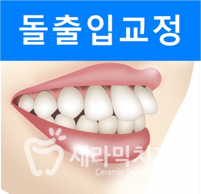 치아교정 전후 스마일라인 변화!(돌출입,토끼앞니, 중심선 비대칭 동시 교정) 관련 이미지 2