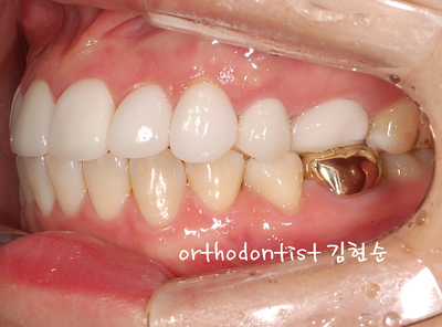 강남 덧니, 돌출 관련 이미지 29