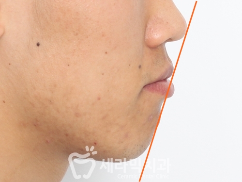 돌출입 치아교정전후, 갸름하고 부드러운 옆라인 완성! 관련 이미지 2