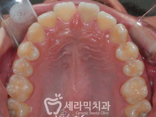 벌어진치아, 앞니벌어짐 치아교정전후 관련 이미지 4