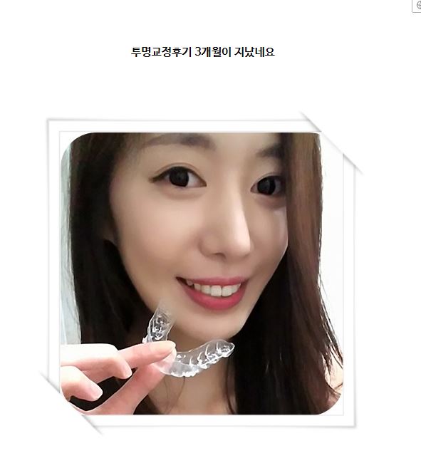 투명교정후기 세라믹치과 ~ 관련 이미지 1