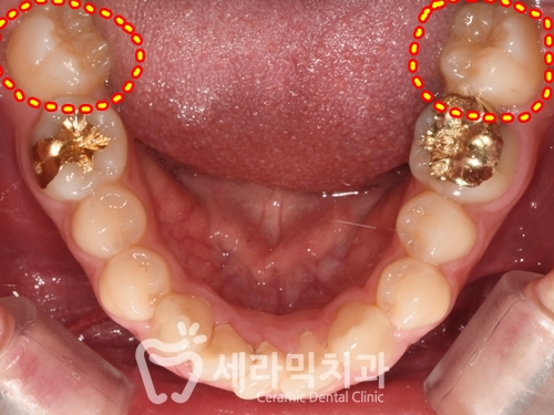 과개교합과 돌출입 개선으로 달라진 인상, 세라믹치과 치아교정전후! 관련 이미지 5