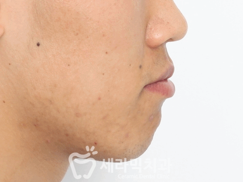 돌출입 치아교정전후, 갸름하고 부드러운 옆라인 완성! 관련 이미지 5