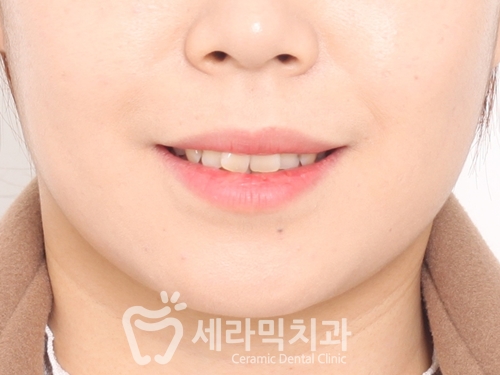 과개교합과 삐뚤빼뚤한 치열, 돌출입 앞니 치아교정전후 관련 이미지 2