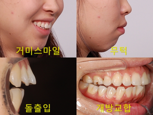 치아교정전후 : 돌출입, 무턱, 개방교합, 거미스마일을 한번에 해결! 관련 이미지 2