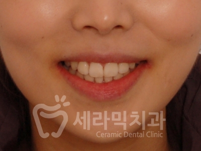 돌출입 덧니 비대칭 치아교정 전후 인상변화! 관련 이미지 14
