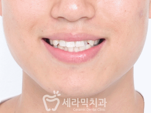 치아배열 치아교정전후 : 함박웃음을 찾은 사례 관련 이미지 6