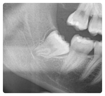 학동역 사랑니발치 관련 이미지 1