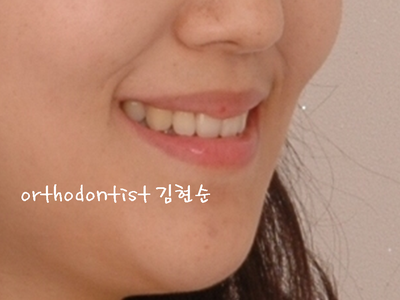 개방 교합 관련 이미지 32