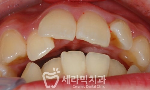 삐뚤빼뚤 치열불규칙 치아교정전후 달라진 미소 관련 이미지 2