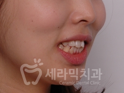 돌출입 덧니 비대칭 치아교정 전후 인상변화! 관련 이미지 7