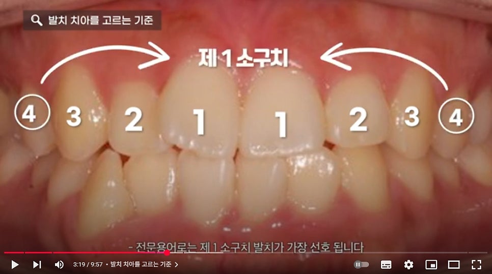 발치교정 vs 비발치교정, 어떤 선택을 해야 후회 없을까? 관련 이미지 3