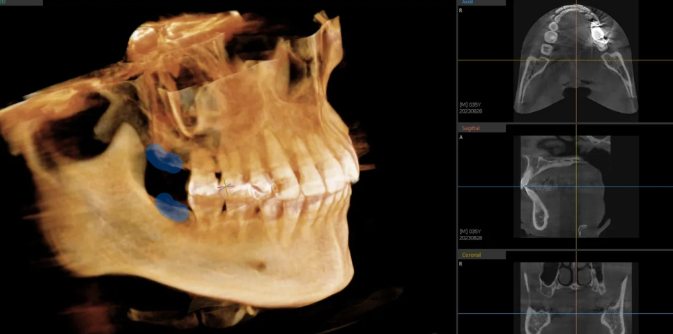 돌출입 재교정, 그것도 세 번째. 관련 이미지 6